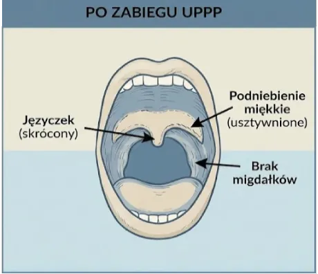 plastyka podniebienia i gardła - leczenie OBS Rzeszów
