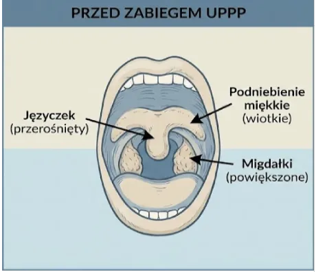 Bezdech senny, chrapanie - Uwulopalatofaryngoplastyka (UPPP) w Rzeszowie
