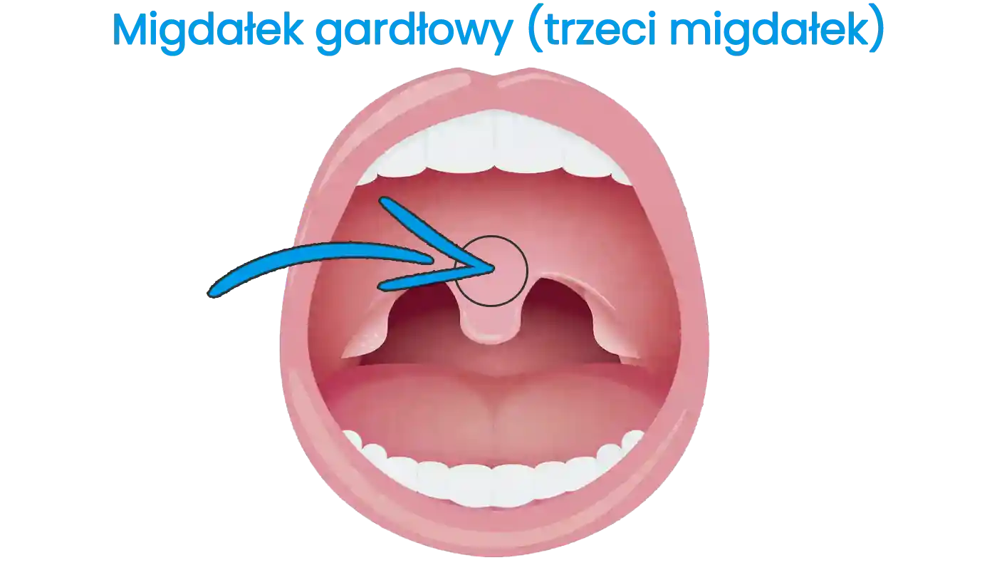 Zabieg adenotomii - wycięcie migdałka gardłowego (trzeciego migdałka) w Rzeszowie