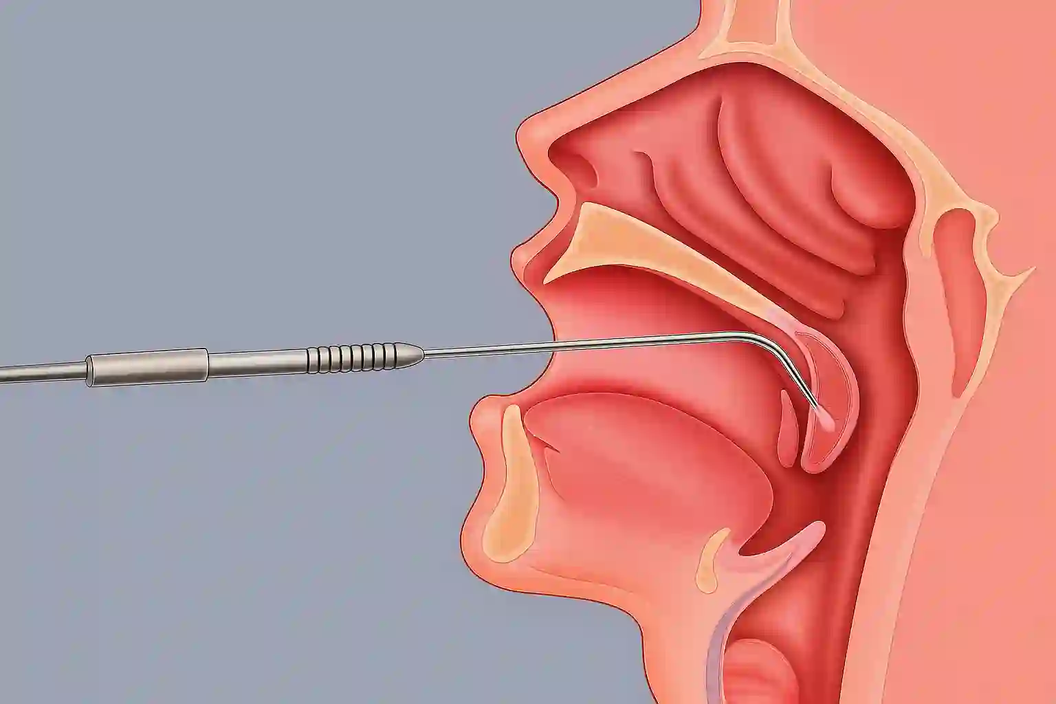 technika ravor zabieg podniebienia Rzeszów
